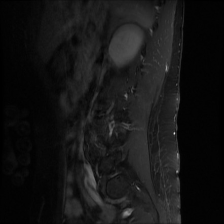 Multiple cauda equina schwannomas in neurofibromatosis type 2 | Image ...