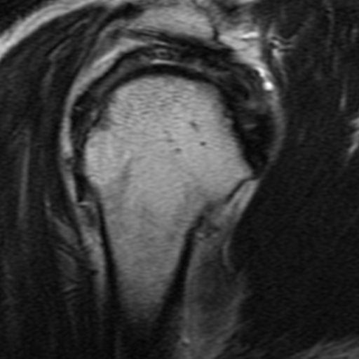 Acromial keel spur | Image | Radiopaedia.org