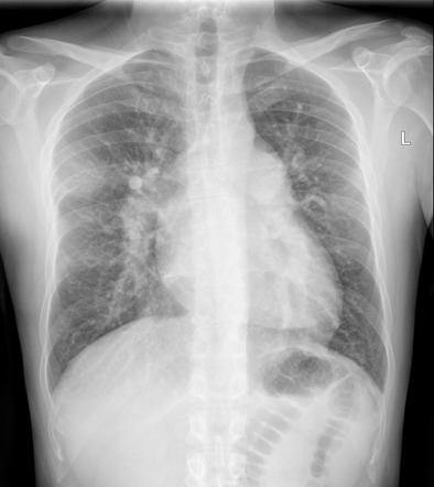 Ventricular septal defect | Radiology Case | Radiopaedia.org