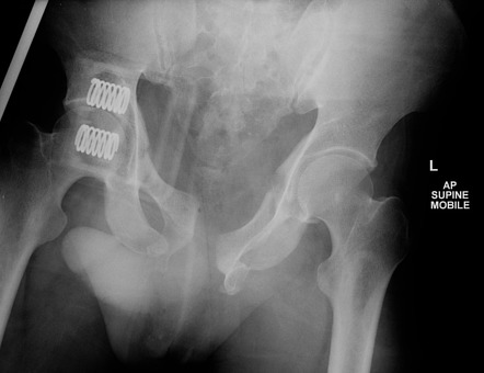 Open book pelvic injury, Radiology Reference Article