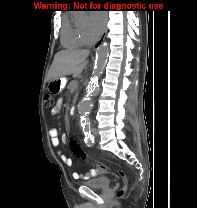 Aortic graft infection | Image | Radiopaedia.org