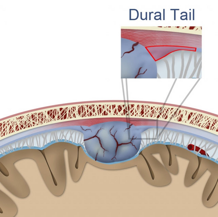 Dural tail sign | Radiology Reference Article | Radiopaedia.org