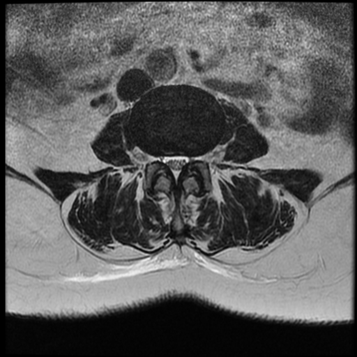 Meningioma thoracic spine | Image | Radiopaedia.org