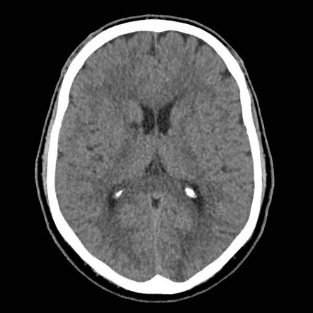 Posterior reversible encephalopathy syndrome - temporal evolution ...