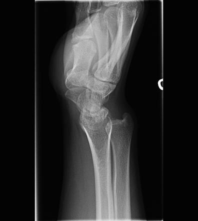 Madelung deformity | Radiology Reference Article | Radiopaedia.org