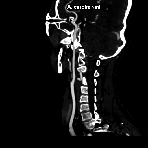 CTA neck - normal exam | Image | Radiopaedia.org