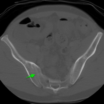 Sacroiliitis | Radiology Reference Article | Radiopaedia.org