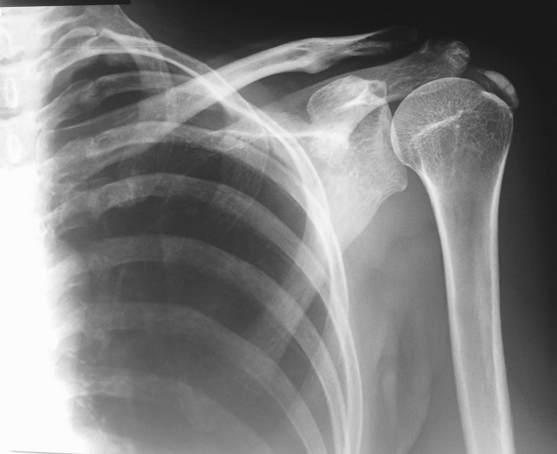 Supraspinatus tendinitis deals