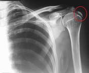 Calcific Tendinitis Radiology Reference Article Radiopaedia Org