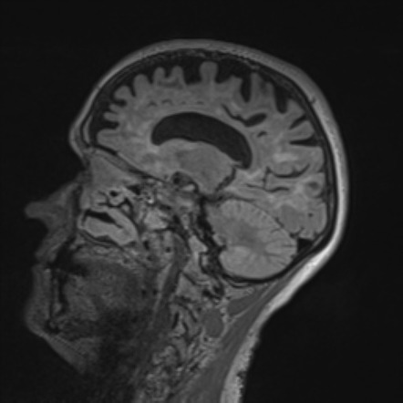 radiopaedia sclerosis sagittal flair