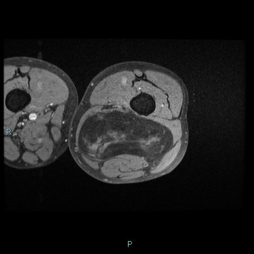 Well-differentiated liposarcoma - thigh | Image | Radiopaedia.org