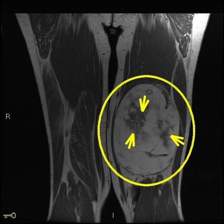 Atypical lipomatous tumor / well-differentiated liposarcoma (ALT/WDLPS ...