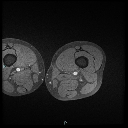 Well-differentiated liposarcoma - thigh | Image | Radiopaedia.org