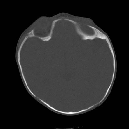 Brachycephaly | Radiology Reference Article | Radiopaedia.org