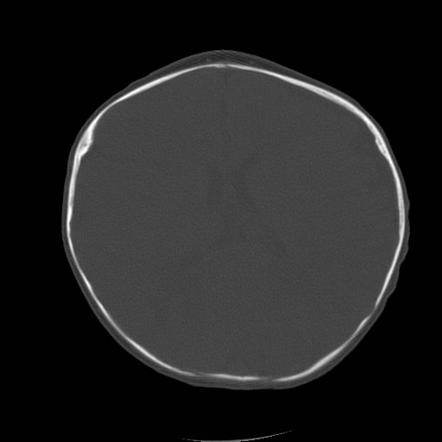 Brachycephaly | Radiology Case | Radiopaedia.org