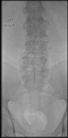 Fluoroscopic guided lumbar puncture | Radiology Case | Radiopaedia.org