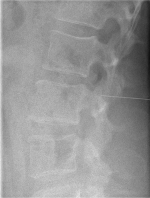 Fluoroscopic guided lumbar puncture | Image | Radiopaedia.org