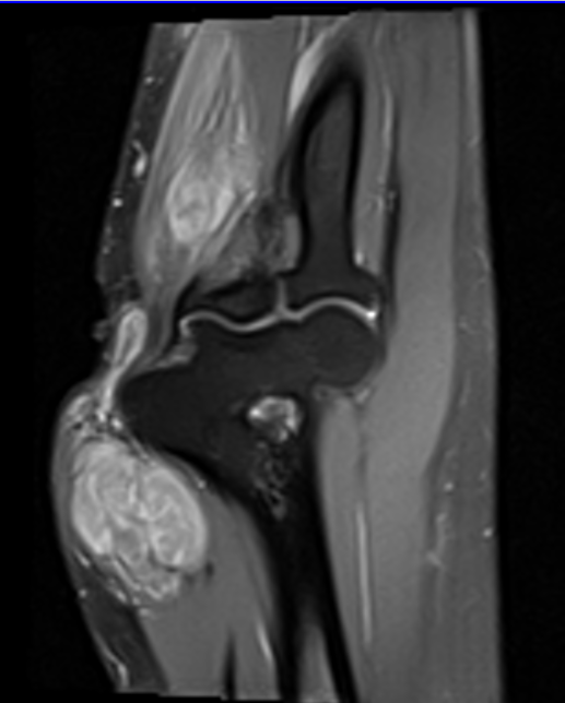 Ulnar Nerve Schwannoma Image