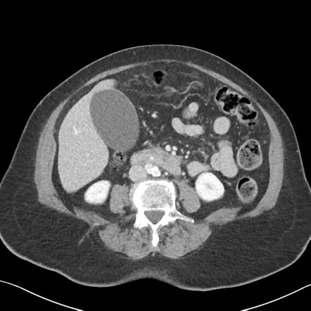 Choledocholithiasis | Image | Radiopaedia.org