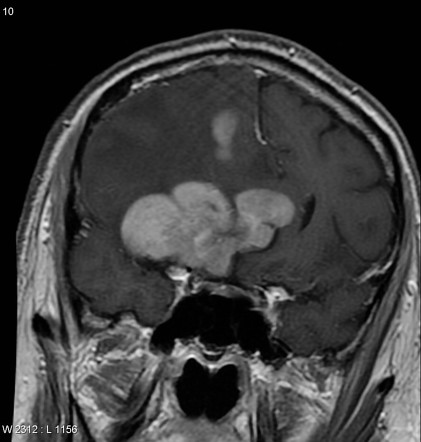 Primary CNS lymphoma | Image | Radiopaedia.org