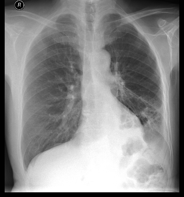 Cureus | Atypical Manifestations of Primary Pulmonary Adenocarcinoma With Signet  Ring Features: A Case Report | Article