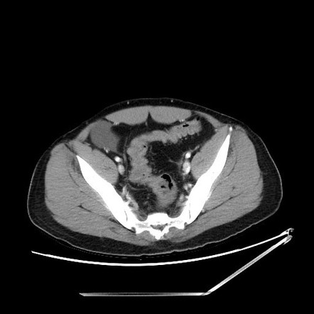 Superior mesenteric vein thrombosis | Radiology Case | Radiopaedia.org