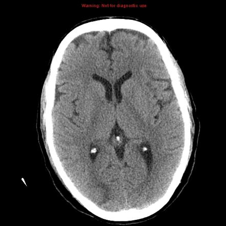 Posterior reversible encephalopathy syndrome | Radiology Case ...