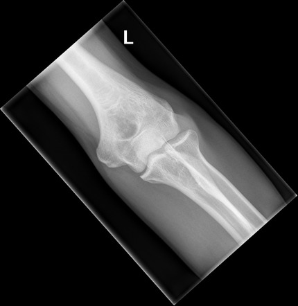 Medial Oblique Elbow X Ray