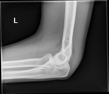 Elbow Joint Effusion Radiology Reference Article Radiopaedia Org