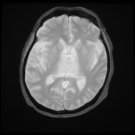 Third ventricular metastasis | Image | Radiopaedia.org