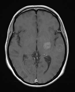 Melanoma metastases: brain | Image | Radiopaedia.org