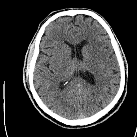 middle cerebral artery stroke case study