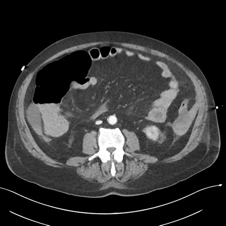 Active splenic bleeding | Image | Radiopaedia.org