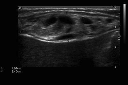 Venolympatic malformation | Radiology Reference Article | Radiopaedia.org