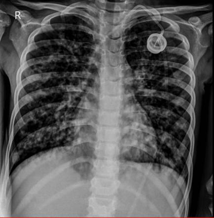 cystic fibrosis case study pltw