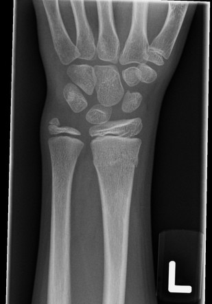 Dorsal Buckle With Ulnar Styloid Avulsion Image Radiopaedia Org