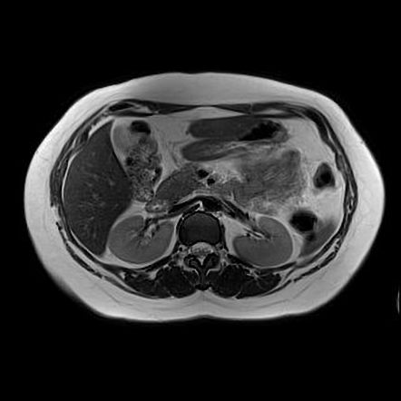 Fibrolamellar Hepatocellular Carcinoma 