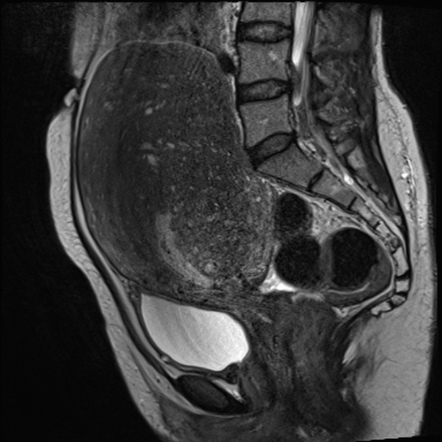 Viewing playlist: Abnormal bleeding clinical aspects: MRI | Radiopaedia.org