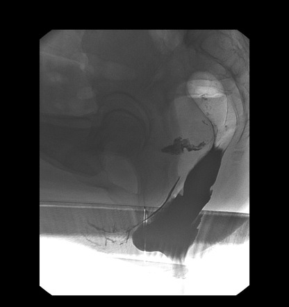 Anterior Rectocoele And Rectal Intussusception Radiology Case