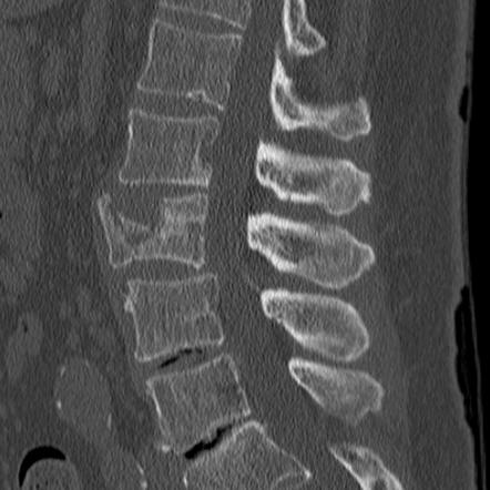 Coronal lumbar vertebral split fracture with endplate depression ...