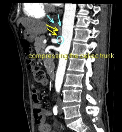 Celiac artery compression syndrome | Radiology Reference Article ...