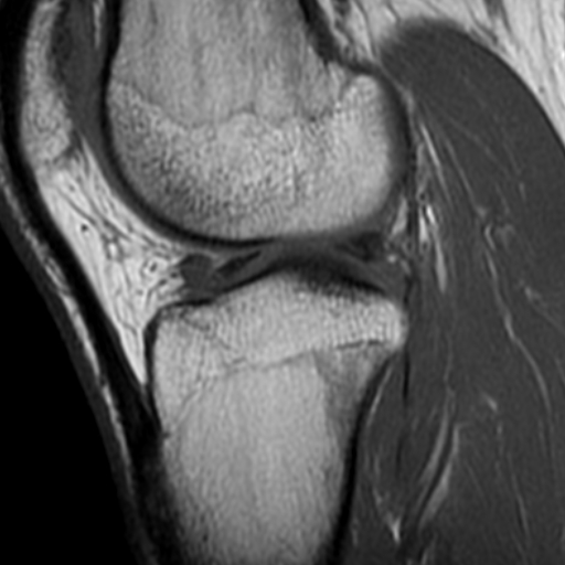 Cystic degeneration of the anterior intermeniscal ligament | Image ...