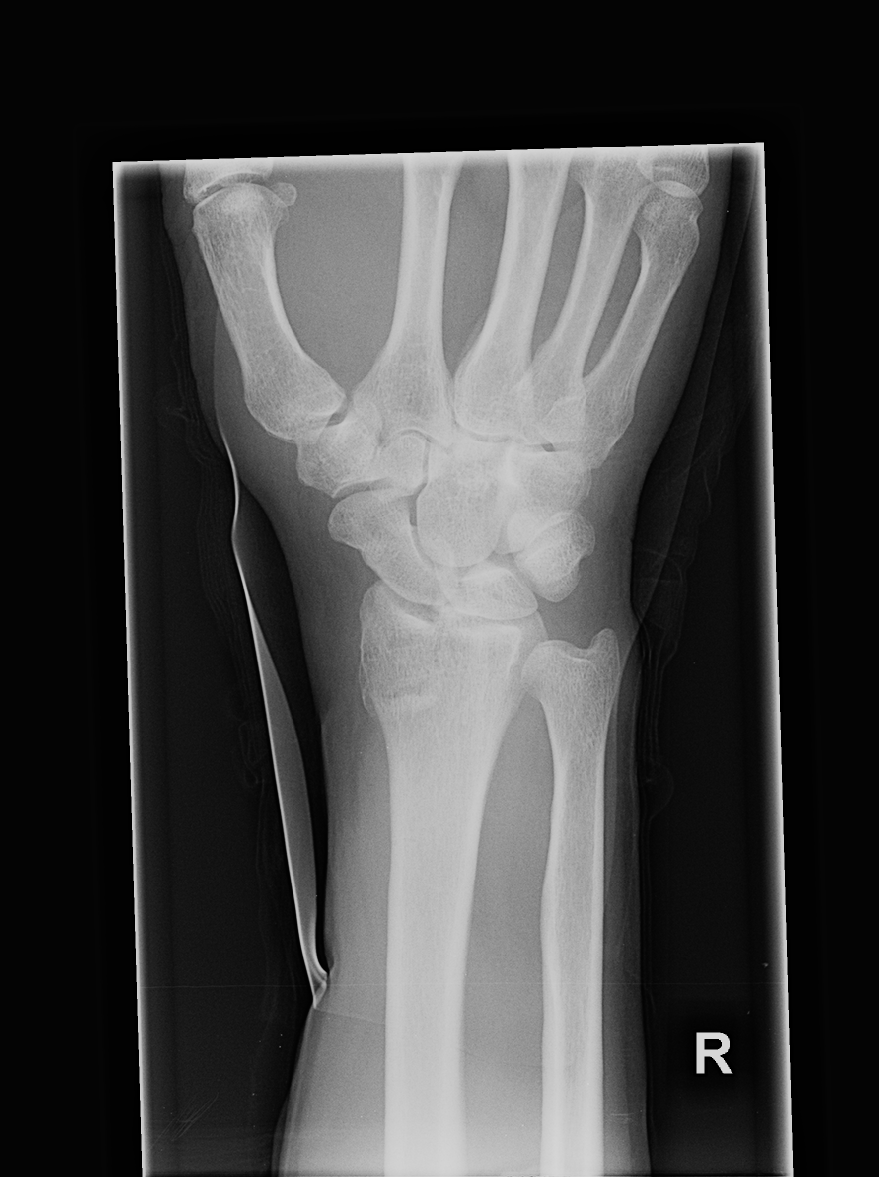 Barton fracture - volar type | Image | Radiopaedia.org