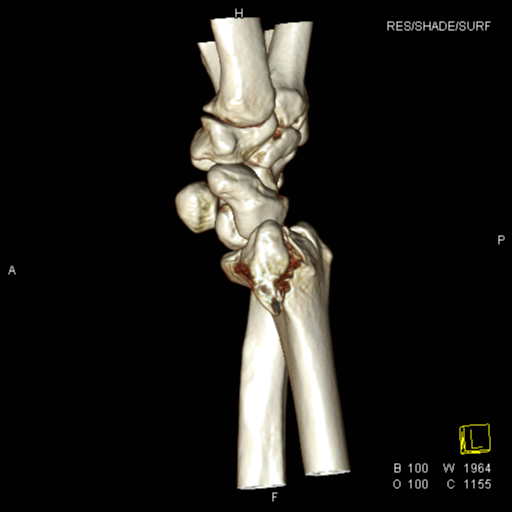 Barton Fracture Volar Type Image