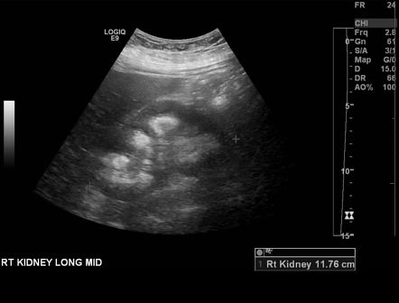 Medullary sponge kidney | Image | Radiopaedia.org