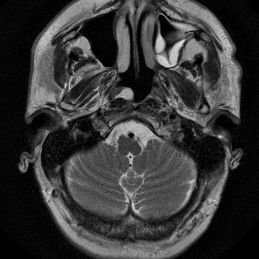 Lateral epipharyngeal cyst | Image | Radiopaedia.org