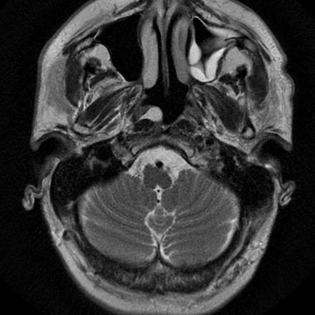 Lateral epipharyngeal cyst | Radiology Case | Radiopaedia.org