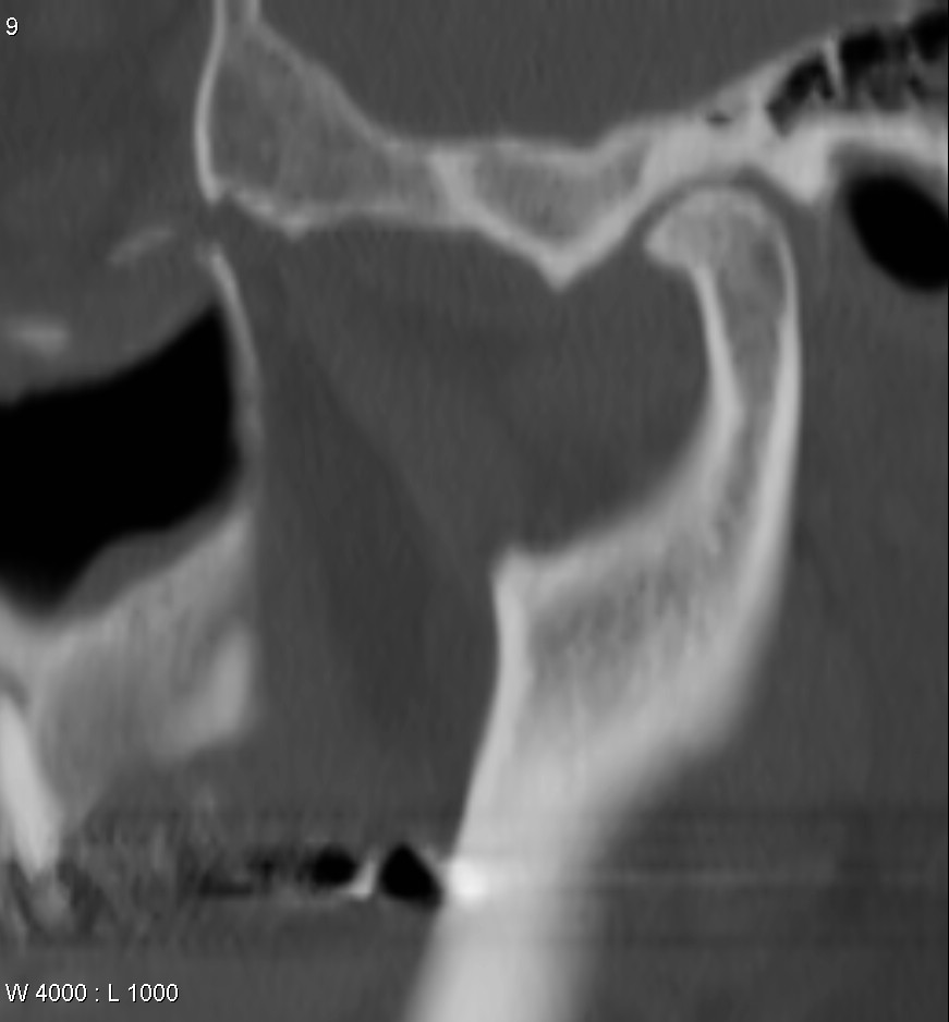 Temporomandibular Joint Osteoarthritis | Image | Radiopaedia.org