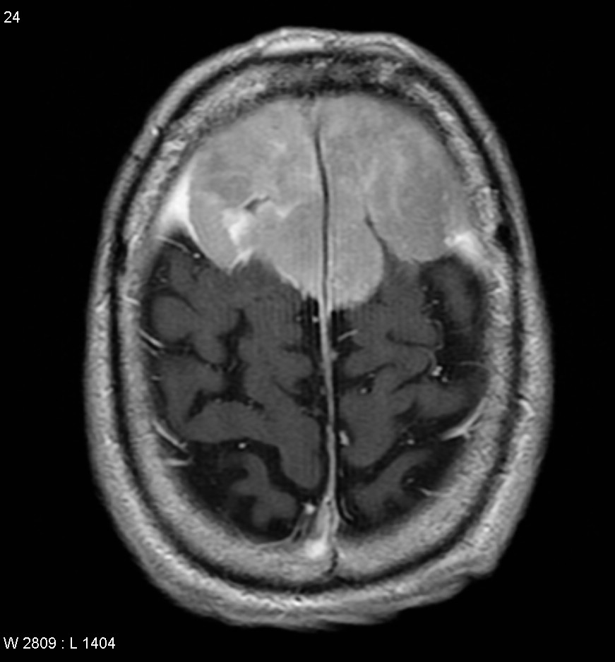 Anaplastic meningioma | Image | Radiopaedia.org