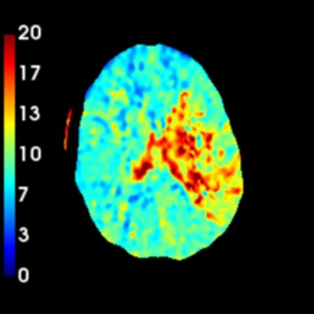 Left MCA and ICA occlusion, endovascular clot retrieval | Image ...